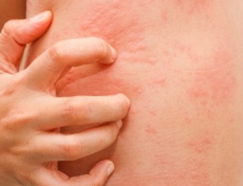 Urticaria: A Common Skin Condition Resulting In Itchy Hives
