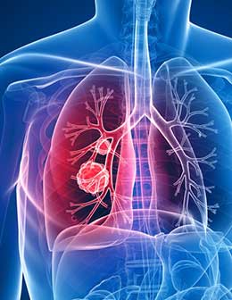 proc-lung-cancer
