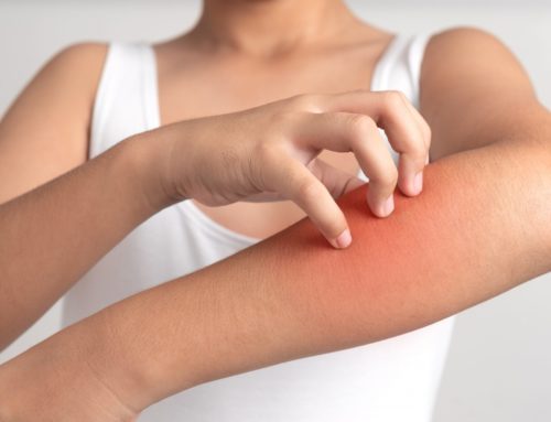 Hives and Itchy Skin at Night : 5 Ways to Ease the Itch and Sleep Better