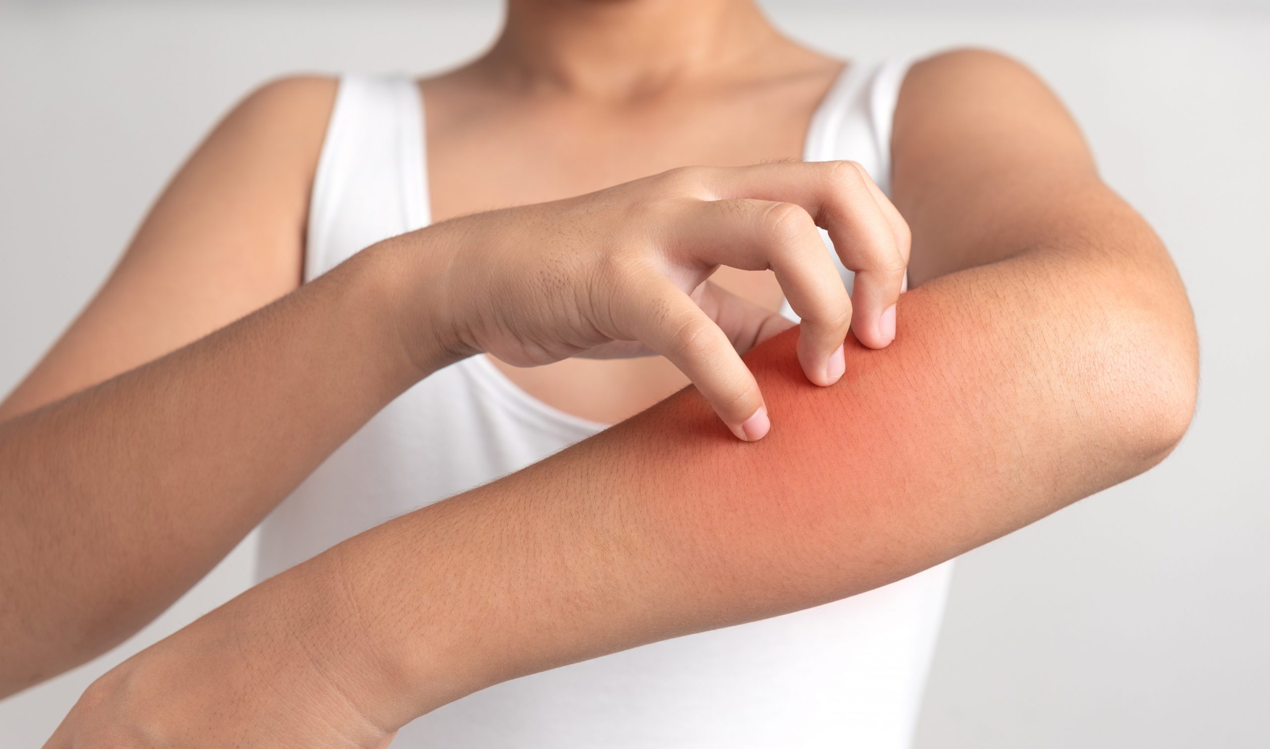 urticaria-a-common-skin-condition-resulting-in-itchy-hives-allergy